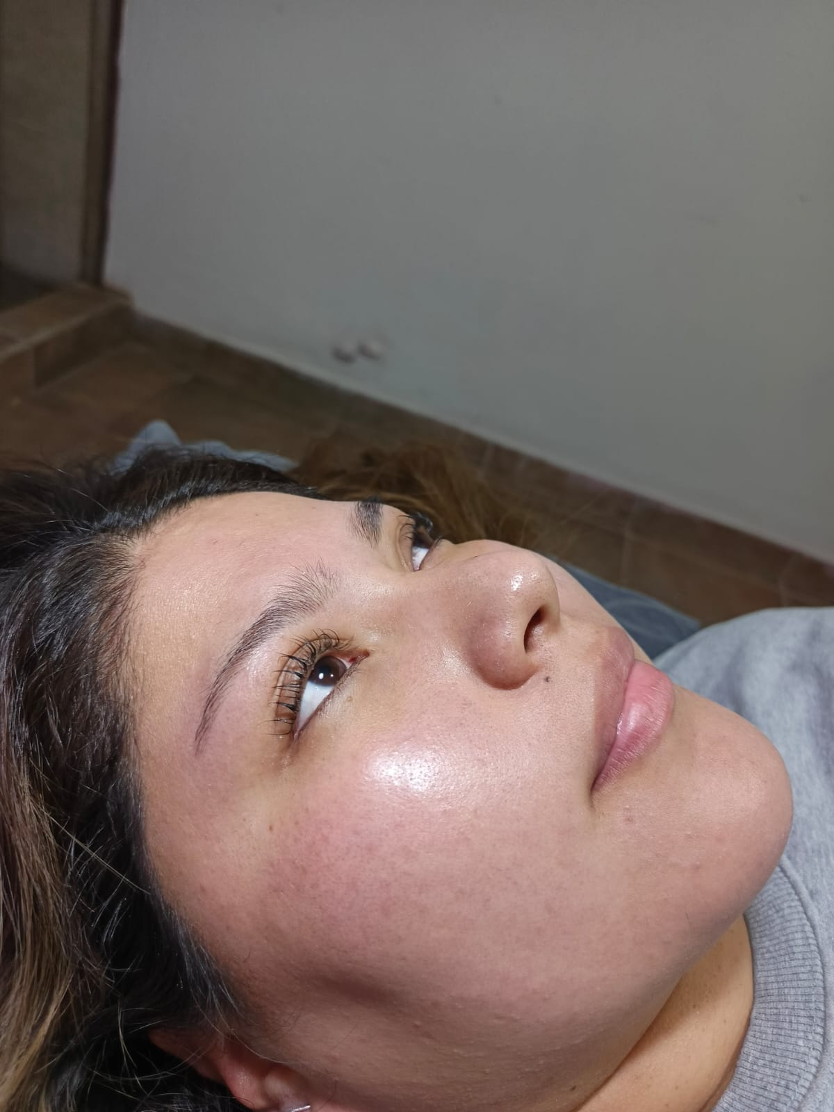 Imagen de después en AzZu Rojas Estética